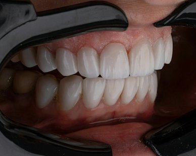 Отбеливание зубов Zoom4