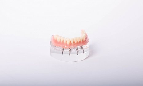 Плюсы и минусы имплантации зубов: Метод All-on-4