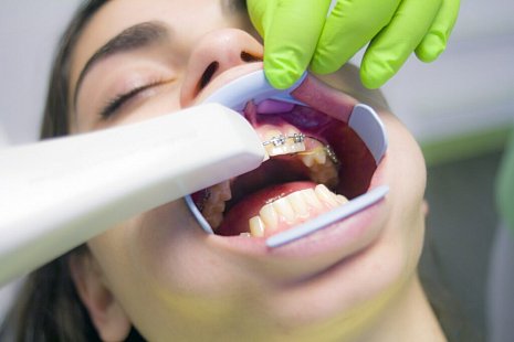 Что делать, если после процедуры отбеливания зубы пожелтели