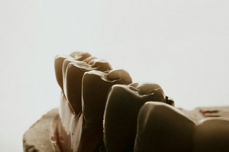 В каких случаях нельзя восстановить зуб при помощи имплантологии