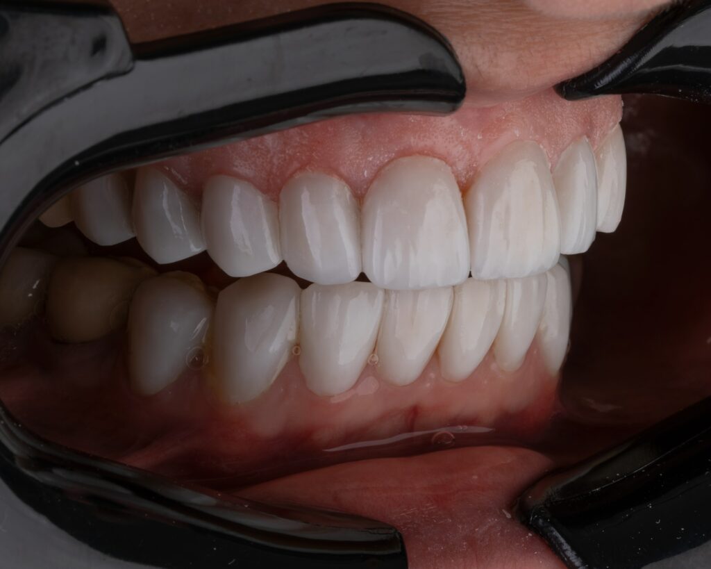 Как отбелить зубы без вреда для эмали